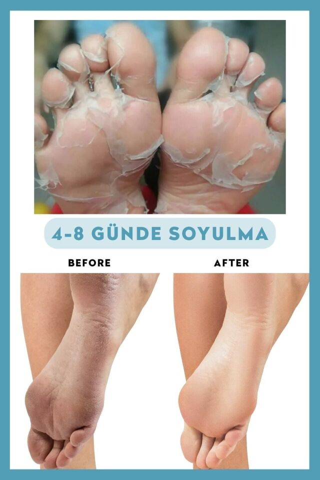 DERMOKİL PEELİNG ETKİLİ SOYULABİLİR AYAK MASKESİ 30 ML